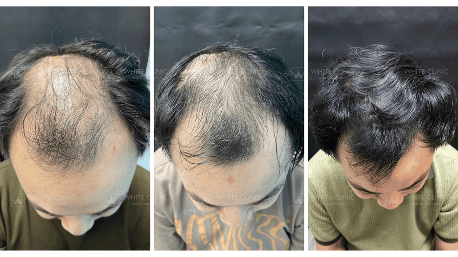 Nguy cơ, tác dụng phụ và tiêu chí chọn nơi điều trị an toàn?
