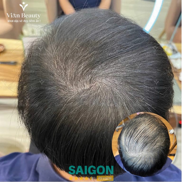 Phòng khám trị rụng tóc TPHCM, Hà Nội và Cần Thơ — chọn địa chỉ uy tín như thế nào?
