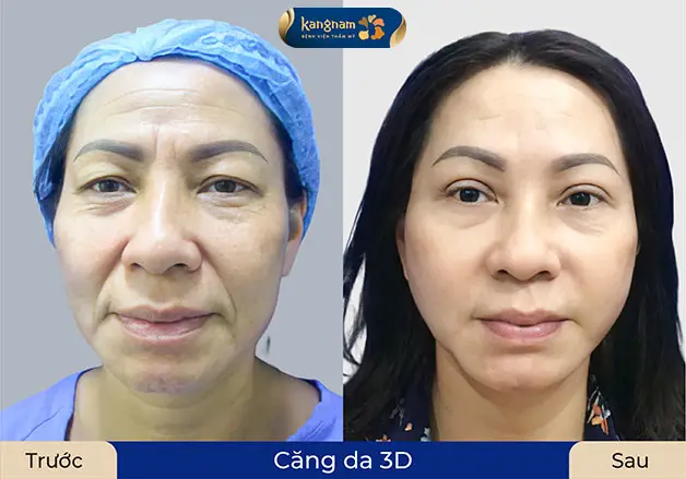 Phẫu thuật căng da mặt được bao lâu — có phải vĩnh viễn không?