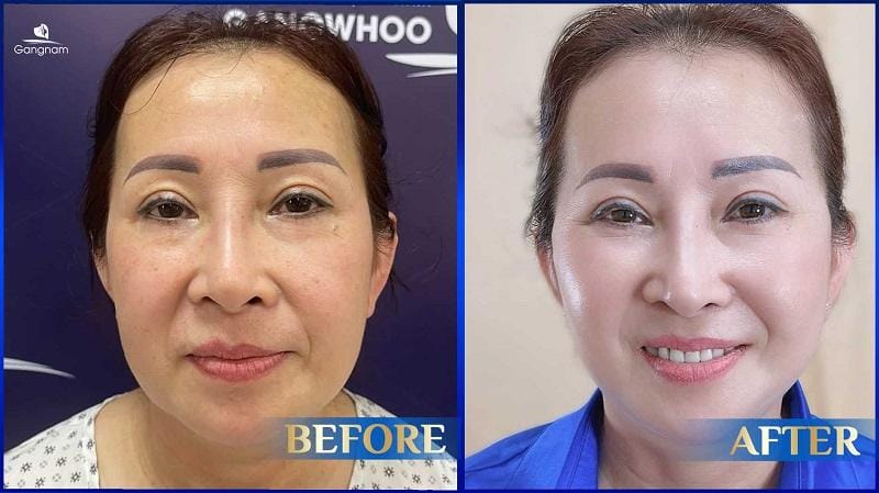Quy trình một ca căng da mặt diễn ra như thế nào và thời gian hồi phục ra sao?
