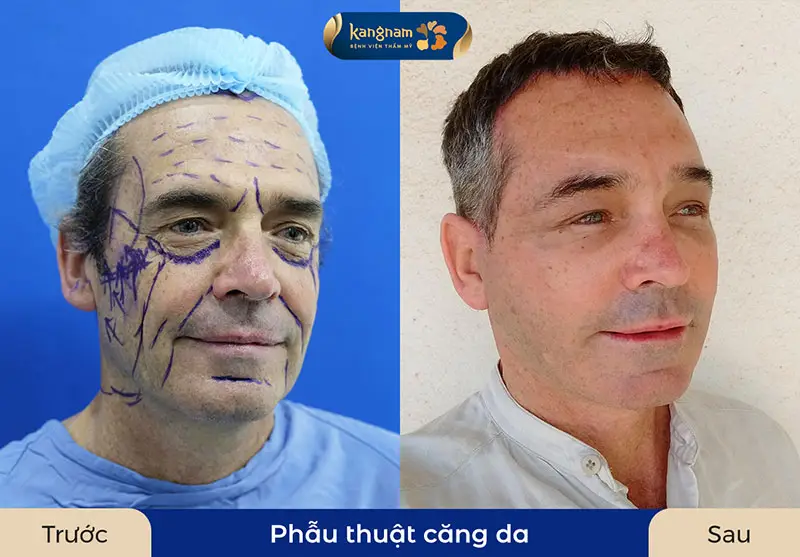 Khi nào nên cân nhắc làm lại (revision) và làm sao để chọn nơi thực hiện an toàn?