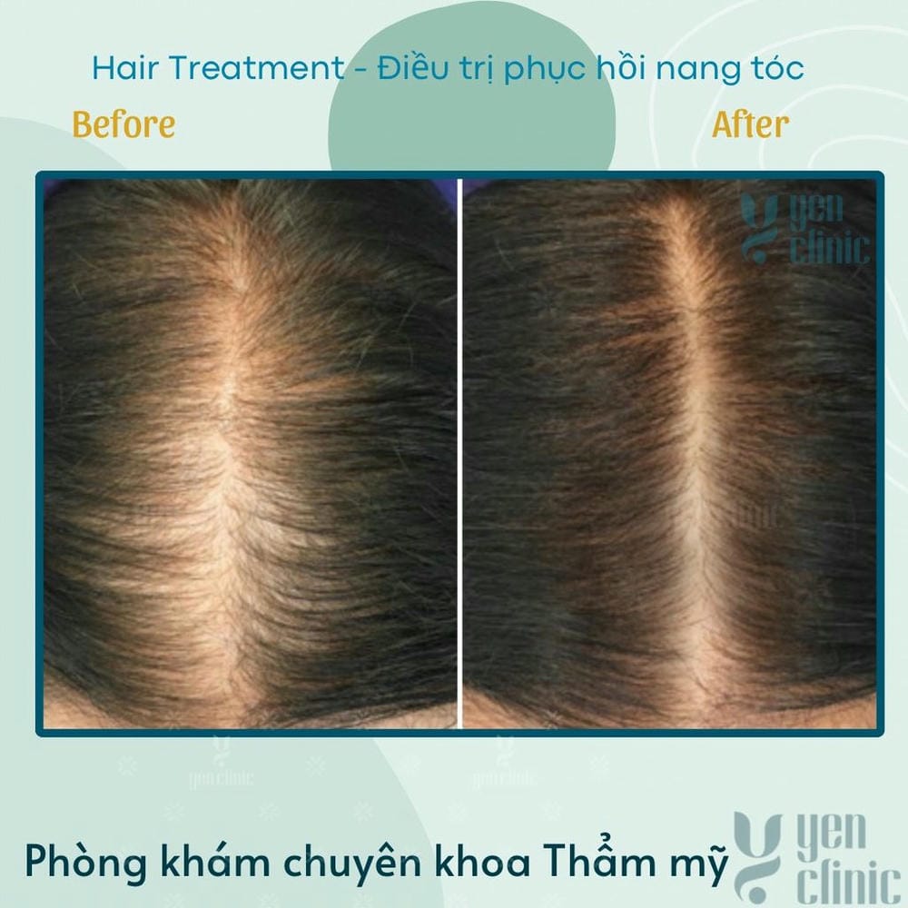 Quy trình điều trị phục hồi nang tóc an toàn tại phòng khám chuyên sâu như Lona Skin Lab — thường diễn ra thế nào?