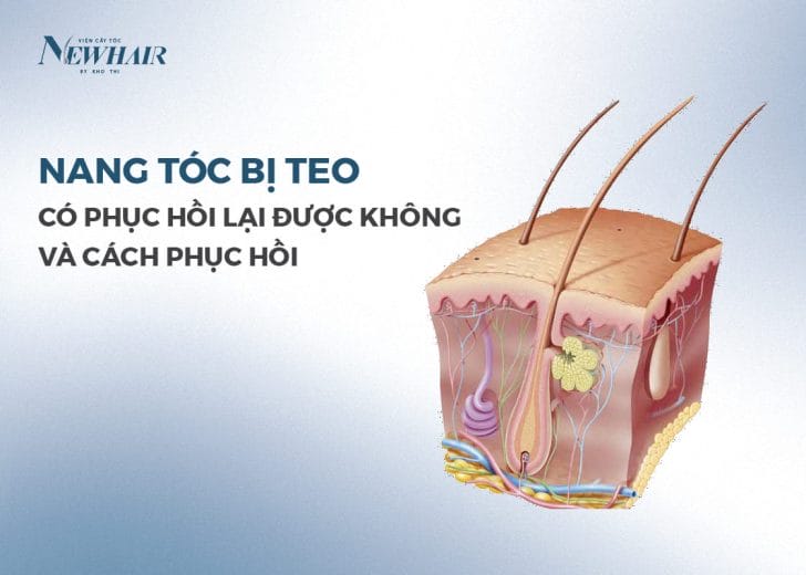 Rủi ro, tác dụng phụ và những ai không nên thực hiện liệu pháp phục hồi nang tóc?
