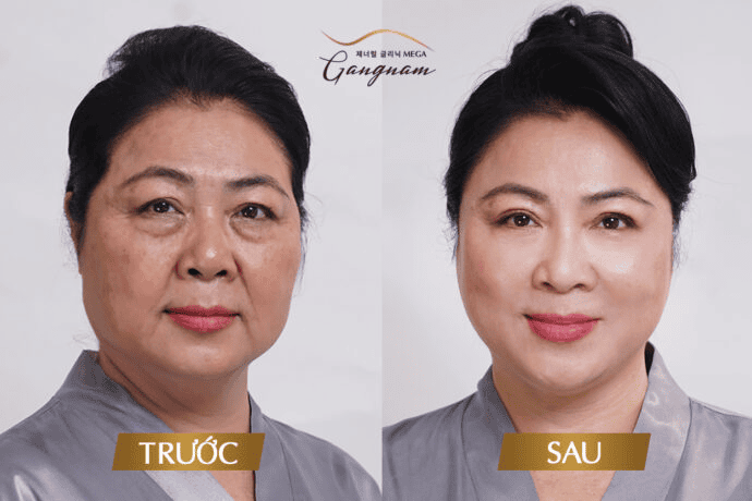 Căng da mặt phẫu thuật và căng chỉ — ưu điểm, nhược điểm và rủi ro