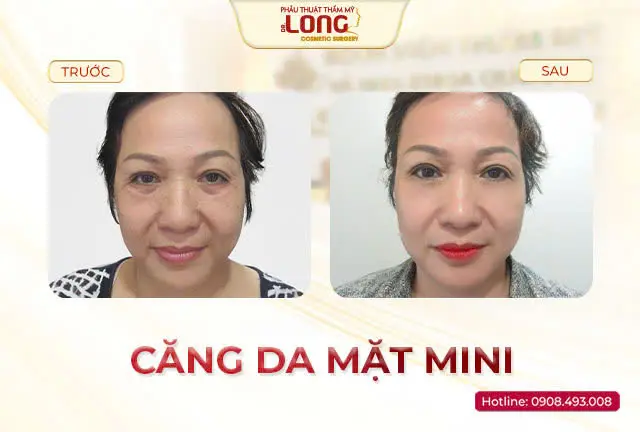 Căng chỉ không phẫu thuật
