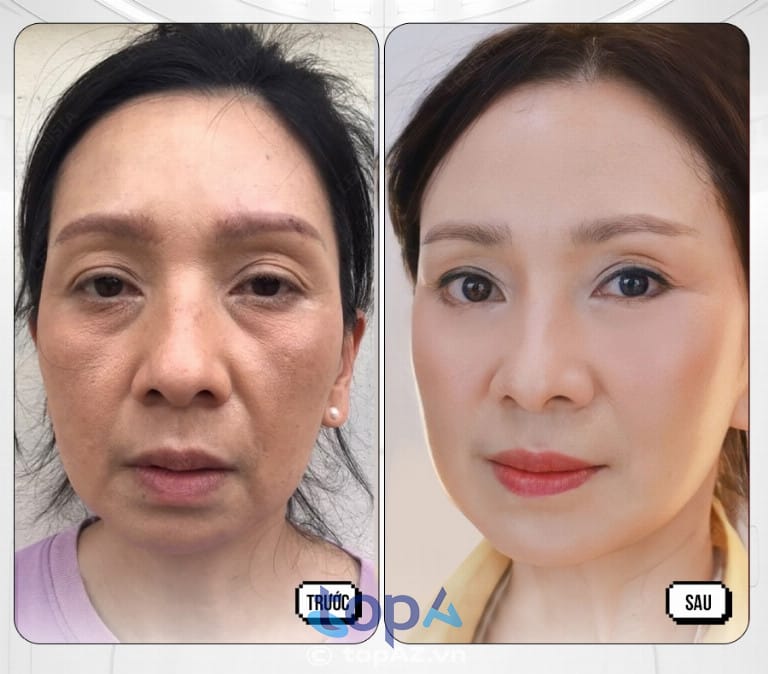 Trước thủ thuật