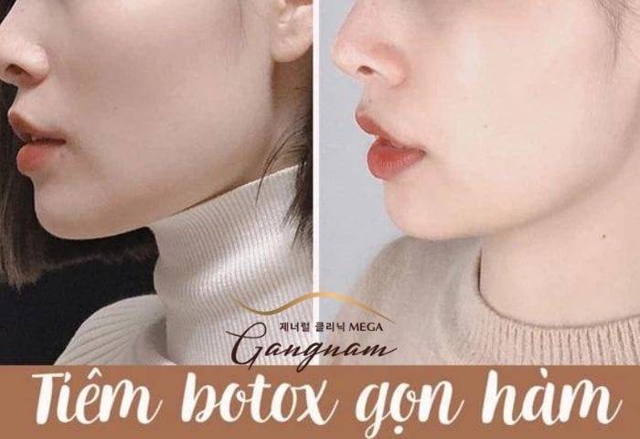 Nhãn hàng botox phổ biến tại Việt Nam và tiêu chí chọn sản phẩm