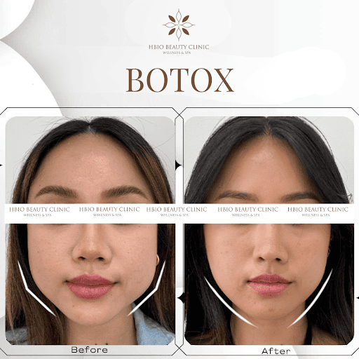 Tiêm botox gọn hàm (tiêm masseter) hoạt động như thế nào — hiệu quả thấy sau bao lâu và kéo dài bao lâu?