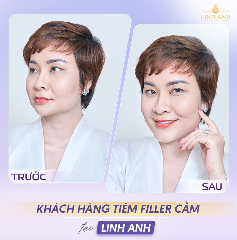 Tiêm filler cằm có nguy cơ gì — dấu hiệu biến chứng sớm cần biết là gì?