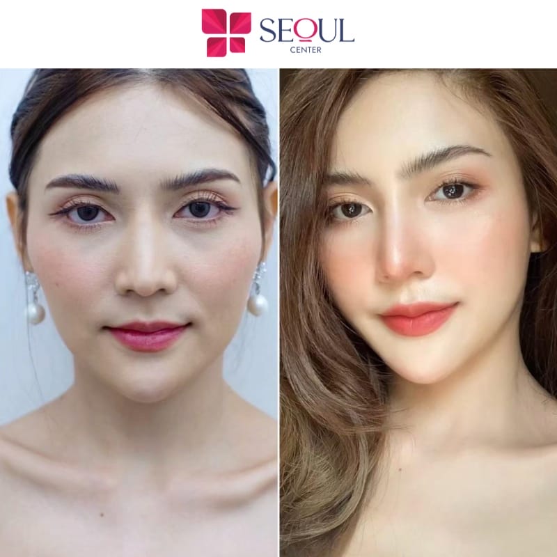 Chất làm đầy nào phù hợp cho cằm — so sánh HA với các chất kích thích/ bán vĩnh viễn?