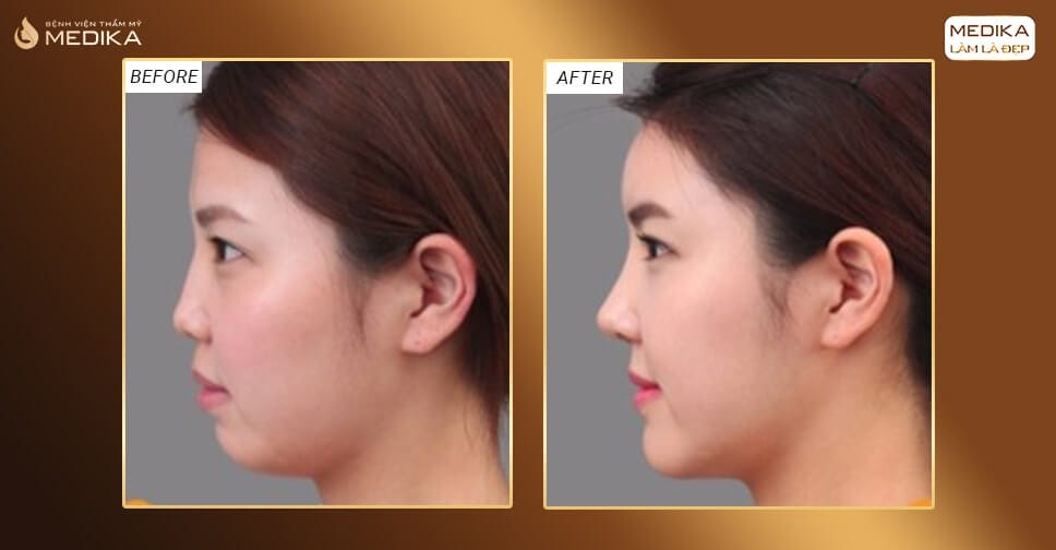 Quy trình tiêm filler cằm an toàn chuẩn tại phòng khám — các bước nào cần lưu ý?