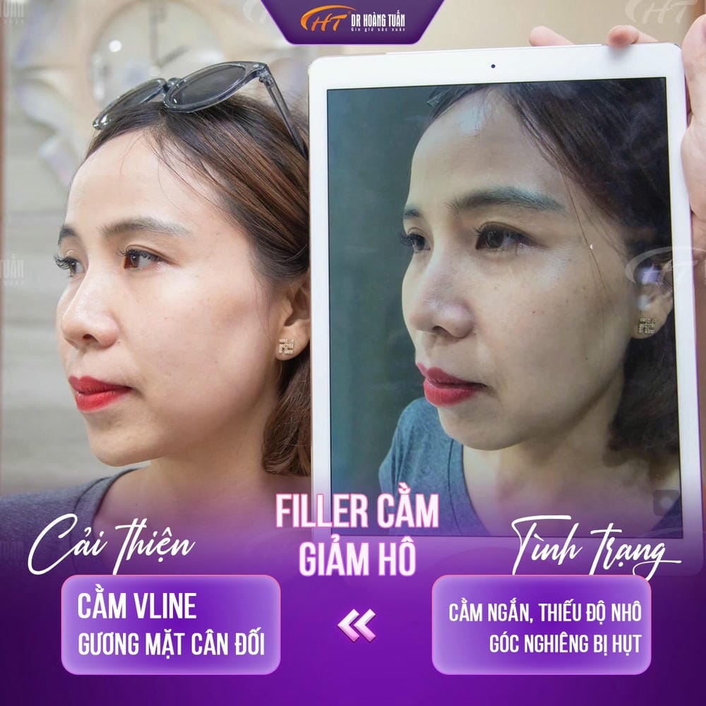 Chi phí tiêm filler cằm phụ thuộc vào những yếu tố nào?
