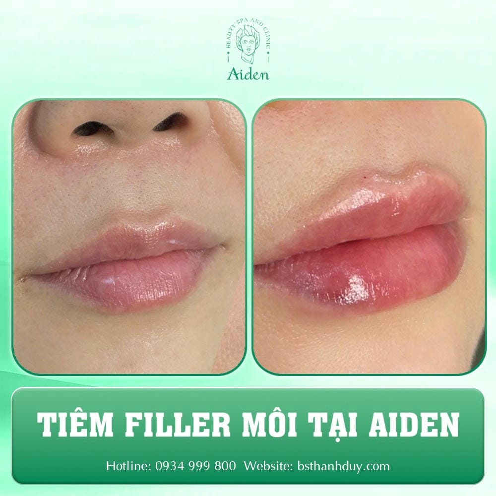 Mức độ an toàn và biến chứng tiêm filler môi cần biết