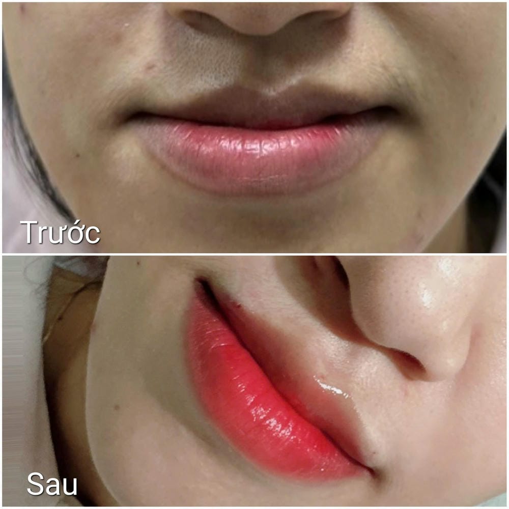Quy trình tiêm filler môi an toàn bao gồm những bước nào?
