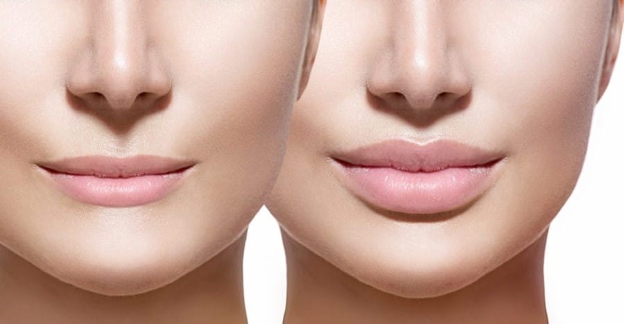 Hiệu quả tiêm filler HA cho môi và tần suất tác dụng phụ