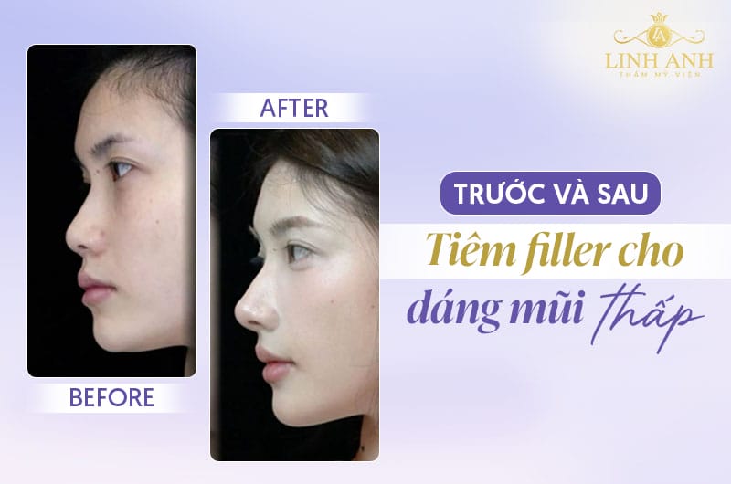 Tiêm filler mũi có thể gây mù hoặc hoại tử không — vì sao xảy ra biến chứng filler mũi nghiêm trọng?