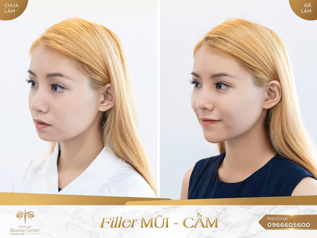Cách chọn địa chỉ tiêm filler uy tín và bác sĩ tiêm mũi an toàn