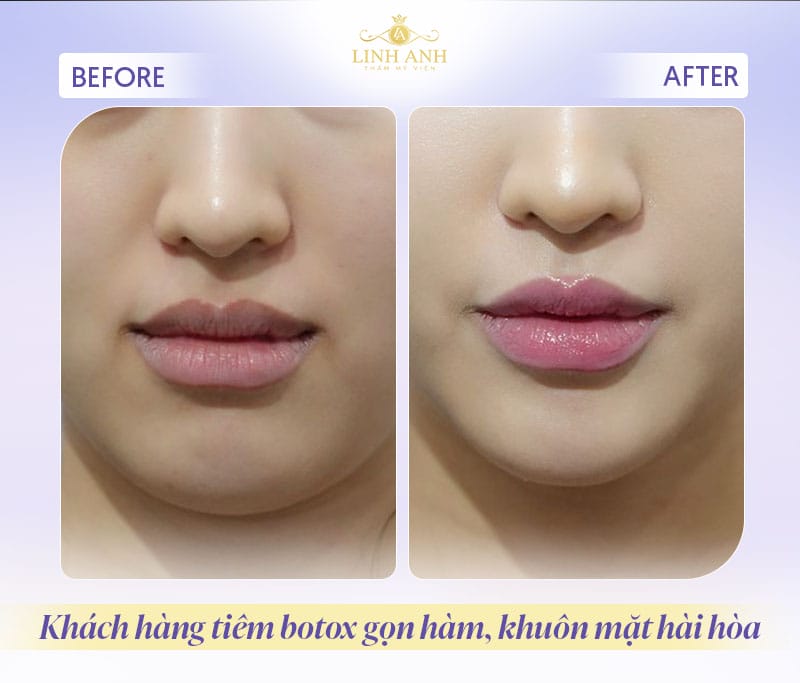 Tiêm gọn hàm bằng botox hay filler để thu gọn góc hàm?