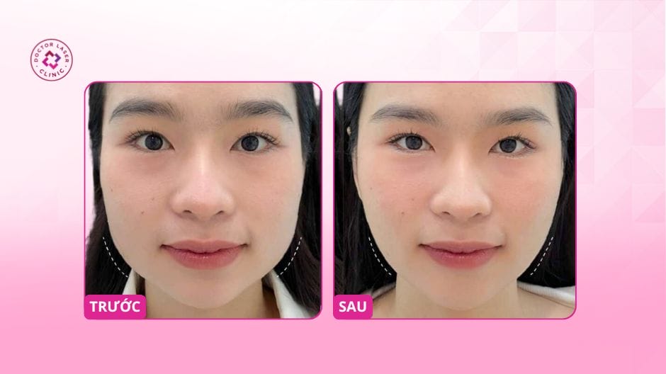 Các kết hợp tối ưu để có gọn hàm tự nhiên — làm sao để tránh mặt móm hoặc mất nét?