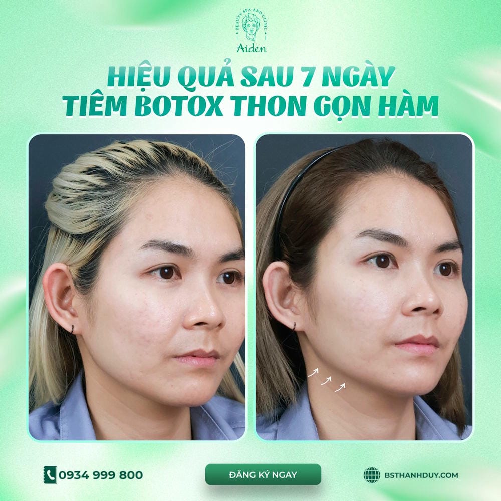 Các điều cần biết về liều và vùng tiêm botox masseter