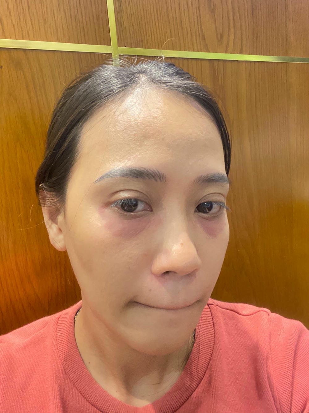 Phương pháp tiêm nào thường dùng — filler quầng thâm, PRP vùng mắt, mesotherapy mắt — ưu nhược điểm?