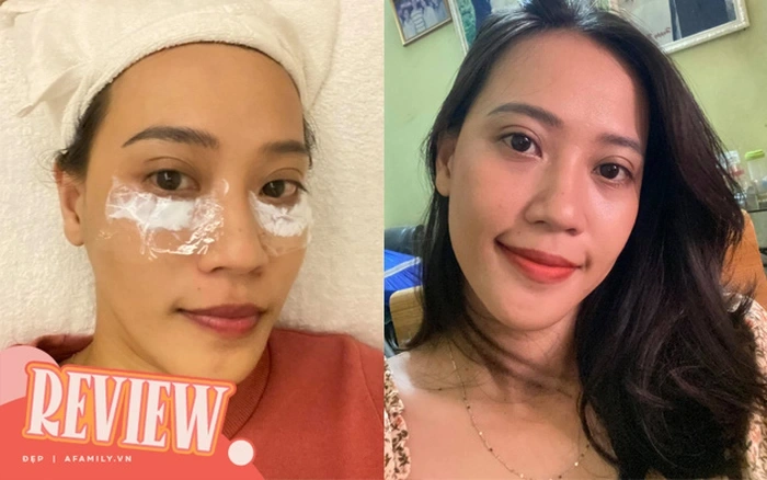 Quy trình tiêm quầng thâm mắt an toàn tại clinic chuẩn phải gồm những bước nào?
