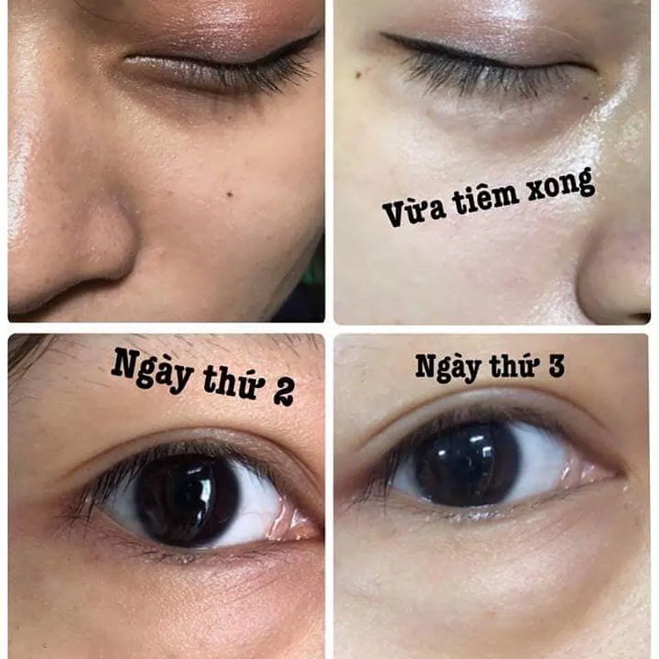 Loại filler nên cân nhắc