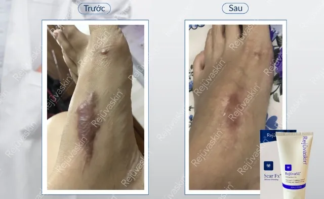 Quy trình tiêm nội sẹo lồi ở clinic diễn ra như thế nào?