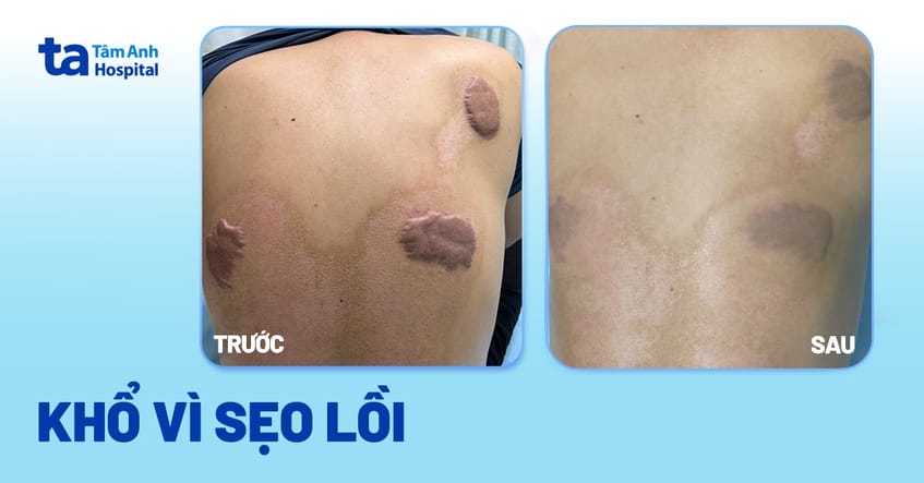 Lưu ý chăm sóc sau tiêm và dấu hiệu cần tái khám ngay?