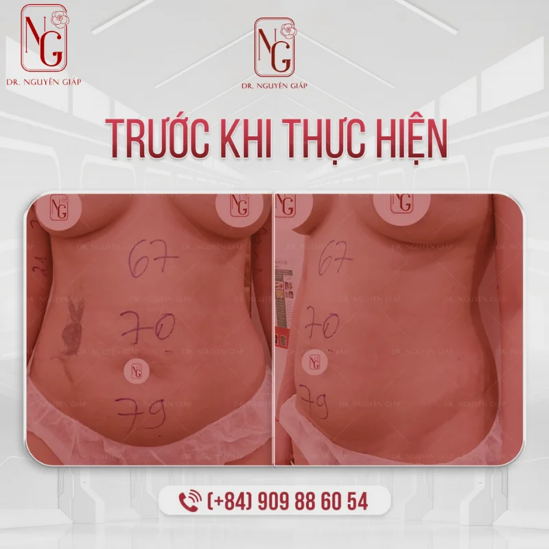 Chi phí tiêm tan mỡ bụng: yếu tố quyết định giá và cách ước tính