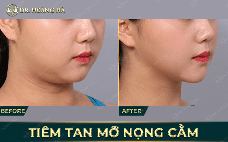 Quy trình tiêm tan mỡ nọng cằm trong một buổi an toàn thường diễn ra như thế nào?