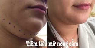 Tiêm tan mỡ có an toàn không? Biến chứng tiêm tan mỡ cần biết