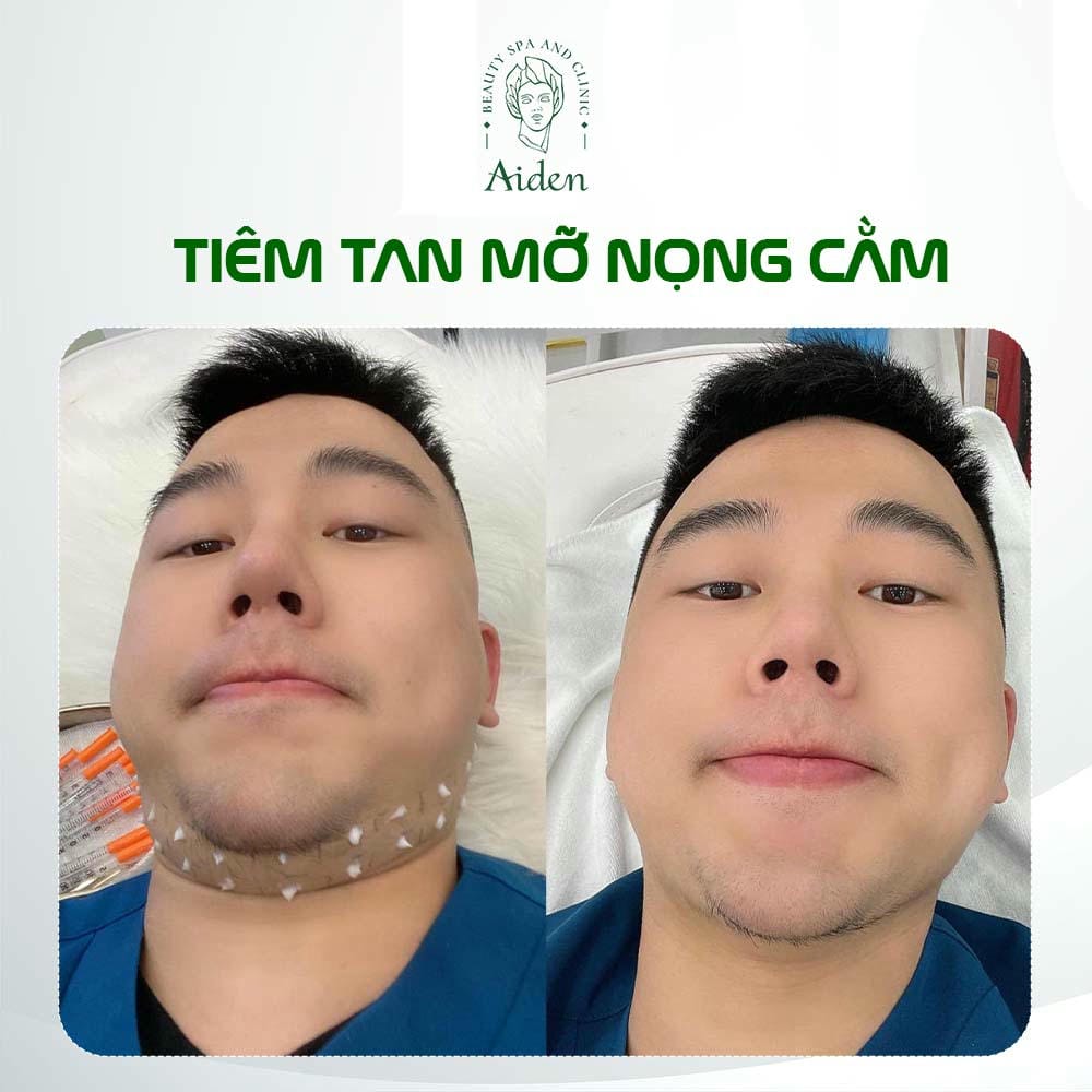 Chi phí tiêm tan mỡ nọng cằm: yếu tố quyết định và mức giá tham khảo