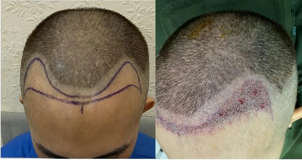 Tại sao tóc rụng theo kiểu androgen ở nam — vai trò của DHT?