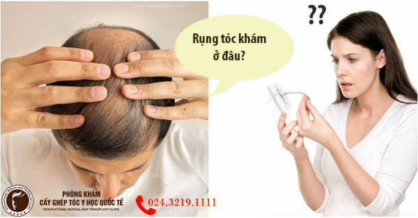 Ưu và nhược điểm — so sánh nhanh các lựa chọn, kể cả cấy tóc