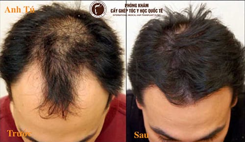 Làm sao chọn nơi khám, điều trị rụng tóc an toàn — checklist cho bệnh nhân?