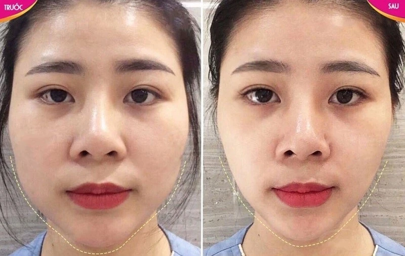Cơ chế tác động của Botox ở cơ cắn (masseter) và những nguy cơ lâu dài cần biết là gì?