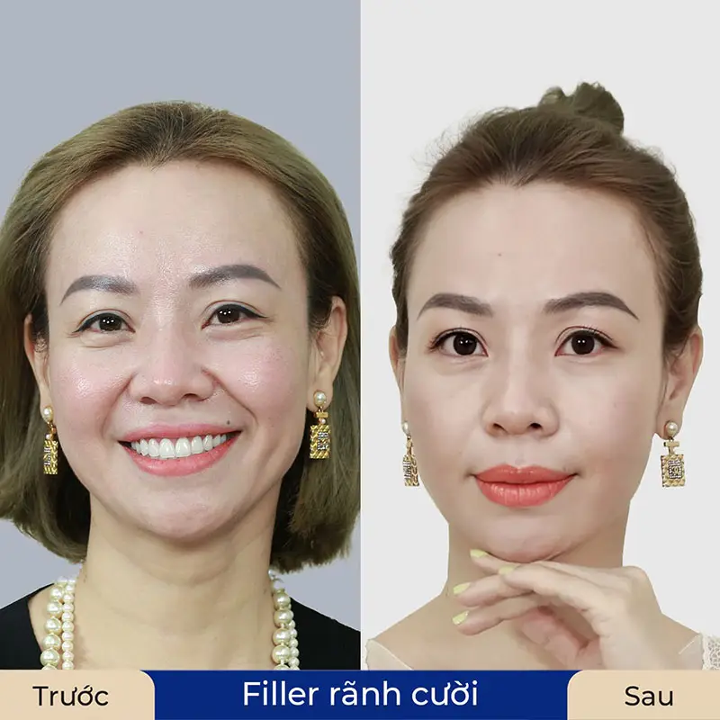 Làm sao biết dấu hiệu biến chứng filler nghiêm trọng — và cần xử trí thế nào?