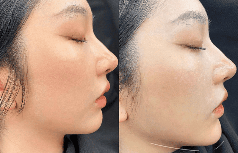 Filler ổn định sau bao lâu — khi nào thấy kết quả cuối cùng?
