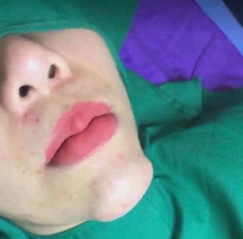 Làm sao phân biệt sưng bình thường với nhiễm trùng, phản ứng muộn hay tắc mạch?