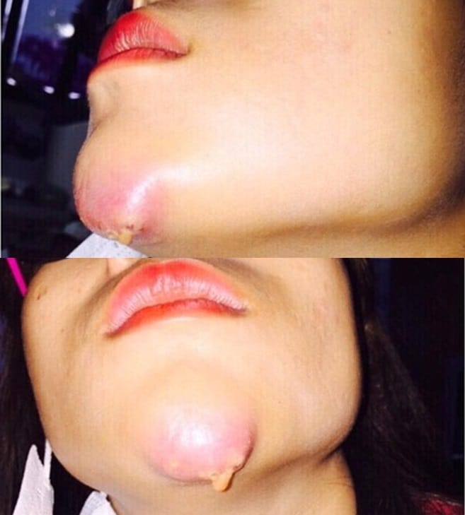 Bằng chứng lâm sàng nào hỗ trợ xử lý sưng và biến chứng do filler?
