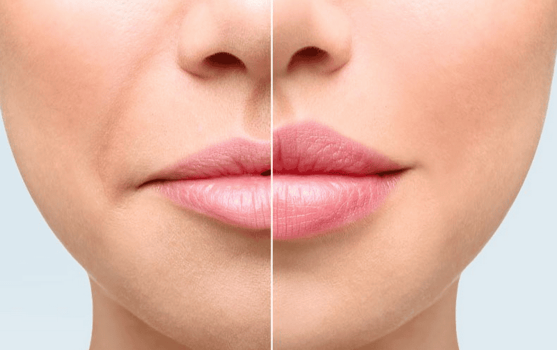 Khi nào nên cân nhắc hòa tan filler — và những điều cần biết về hyaluronidase?