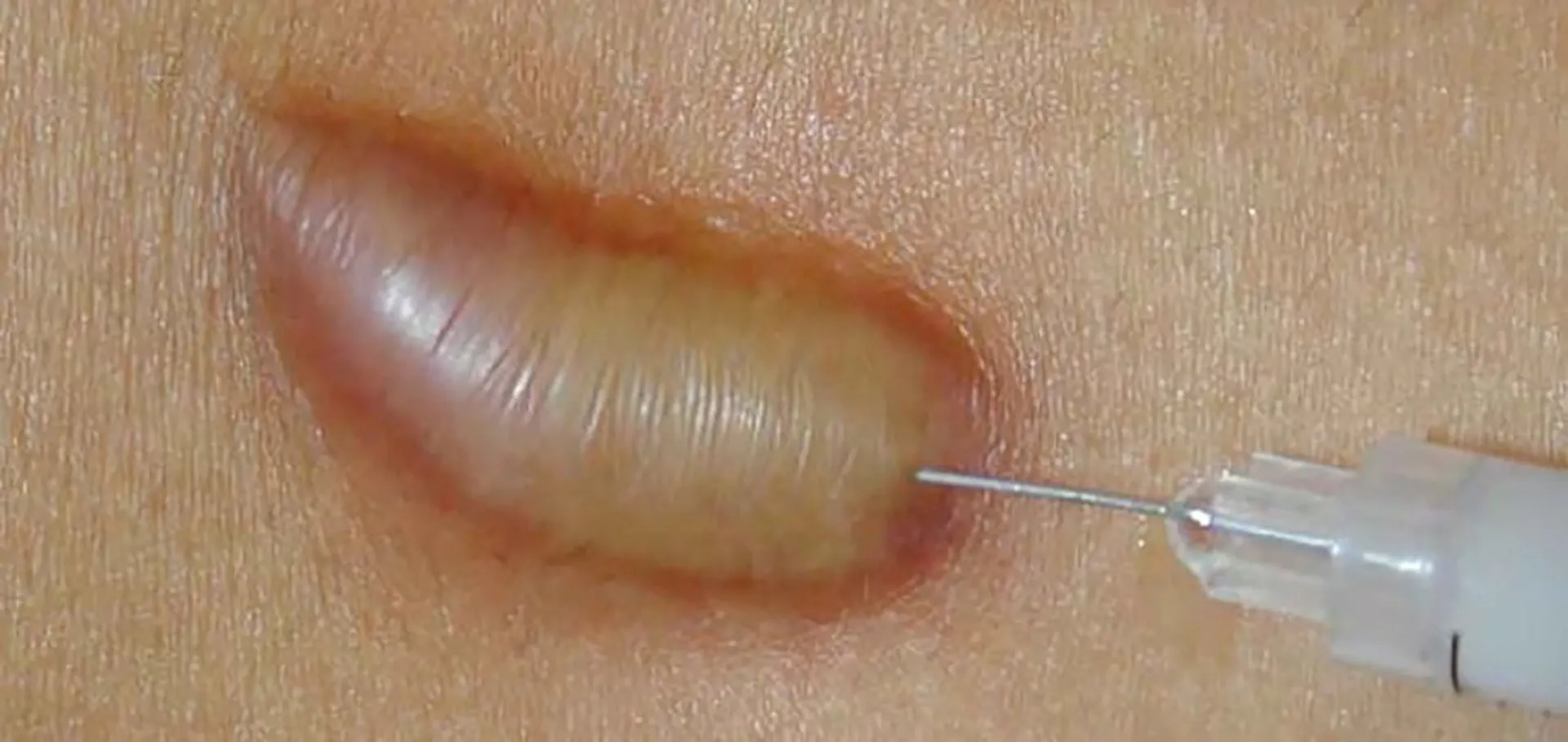 Những lưu ý chăm sóc sau khi tiêm để đạt kết quả tốt hơn?