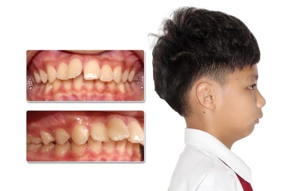 Những lưu ý chăm sóc sau tiêm và những gì cần biết về hồi phục?