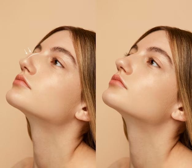 So sánh nhanh: filler, botox, phẫu thuật — chọn gì cho mục tiêu của bạn?