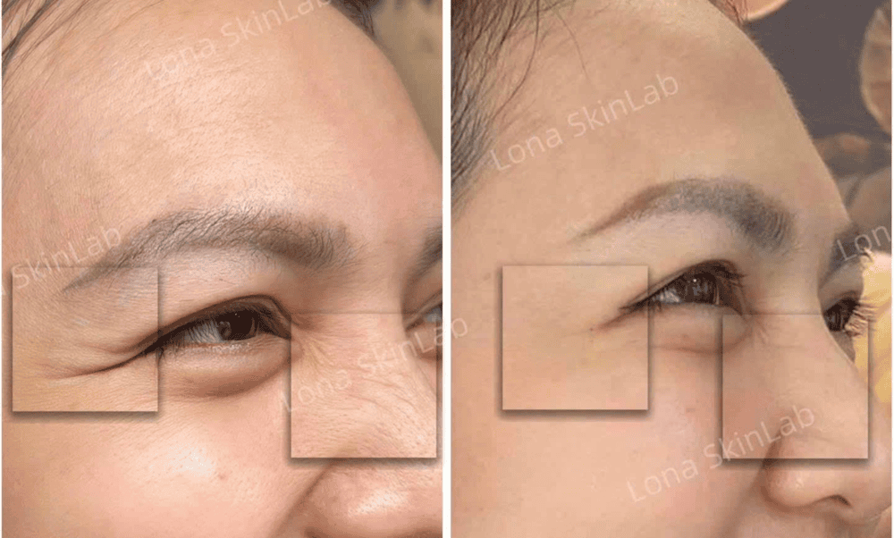 Sau tiêm cần chăm sóc gì và thời gian hiệu quả botox bao lâu?