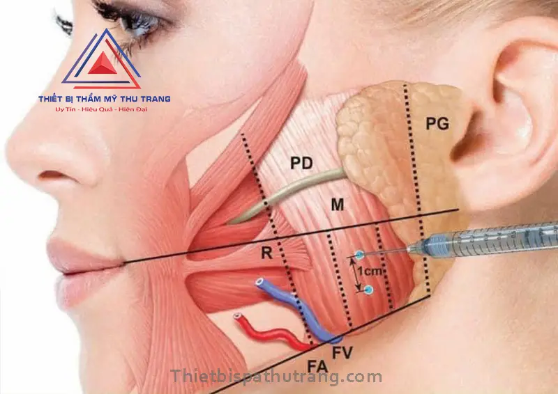 Tiêm "microbotox" (mesobotox) khác gì về thời gian và mục tiêu điều trị?
