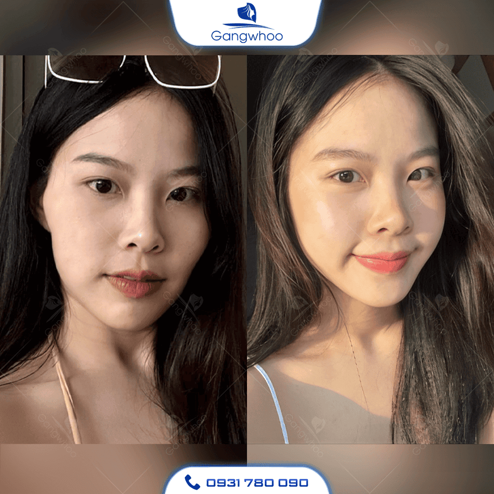 Những hậu quả lâu dài có thể xảy ra nếu lạm dụng hoặc tiêm sai cách?