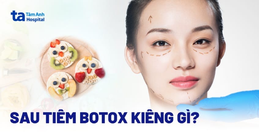 Điểm cần nhớ về “di chuyển” (migration) của Botox