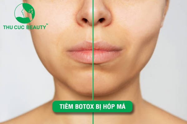Ai dễ bị hóp mặt sau tiêm botox và những yếu tố nguy cơ là gì?